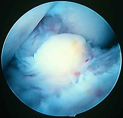 Разрастания фиброзных масс вокруг дистальной части трансплантата.