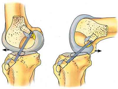 Артроскопический артролиз в лечении контрактур после эндопротезирования коленного сустава