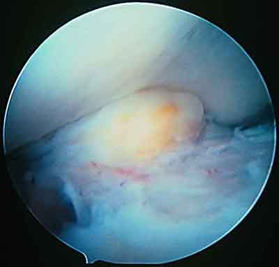 Изображение - Артрофиброз коленного сустава лечение acl02