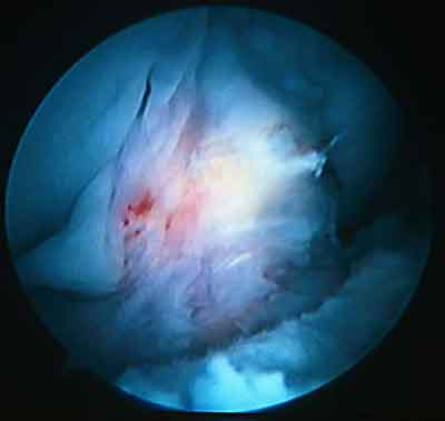 Изображение - Артрофиброз коленного сустава лечение acl03