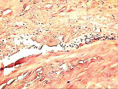 Гистологическая картина некроза трансплантата. Окраска пикрофуксином по Ван-Гизону, увеличение Х 200